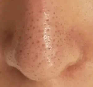 使用前の鼻の状態